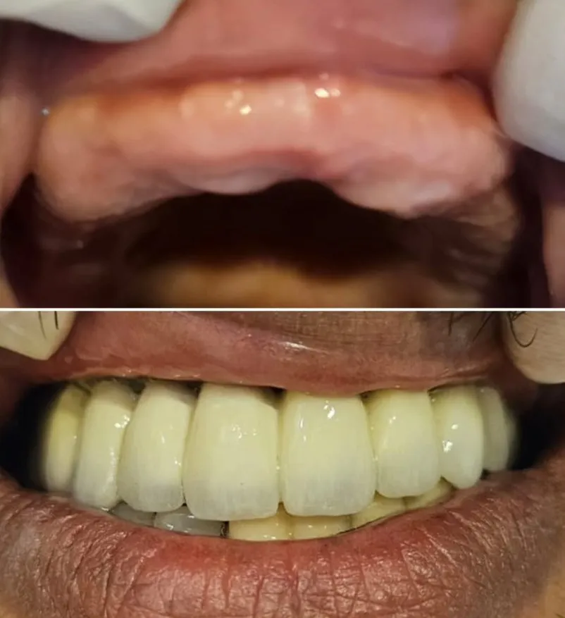 حالة قبل وبعد - زراعة وتركيبات