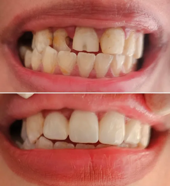 حالة قبل وبعد - تركيبات تجميلية