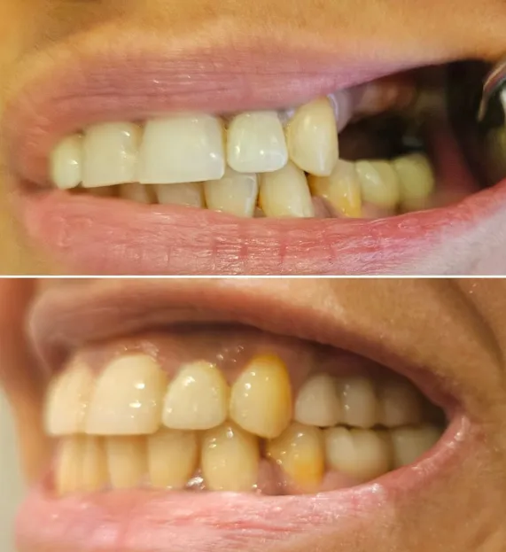 حالة قبل وبعد - تجميل الأسنان