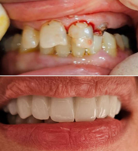 حالة قبل وبعد - تركيبات ثابتة